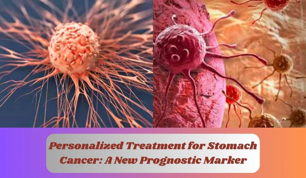 Personalized Treatment for Stomach Cancer: A New Prognostic Marker