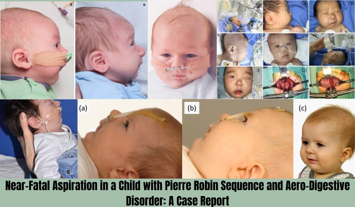 Near-Fatal Aspiration in a Child with Pierre Robin Sequence and Aero-Digestive Disorder A Case Report